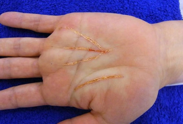 chirurgie esthétique de la paume