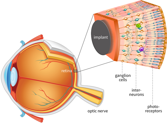 Cette rétine artificielle est révolutionnaire 1